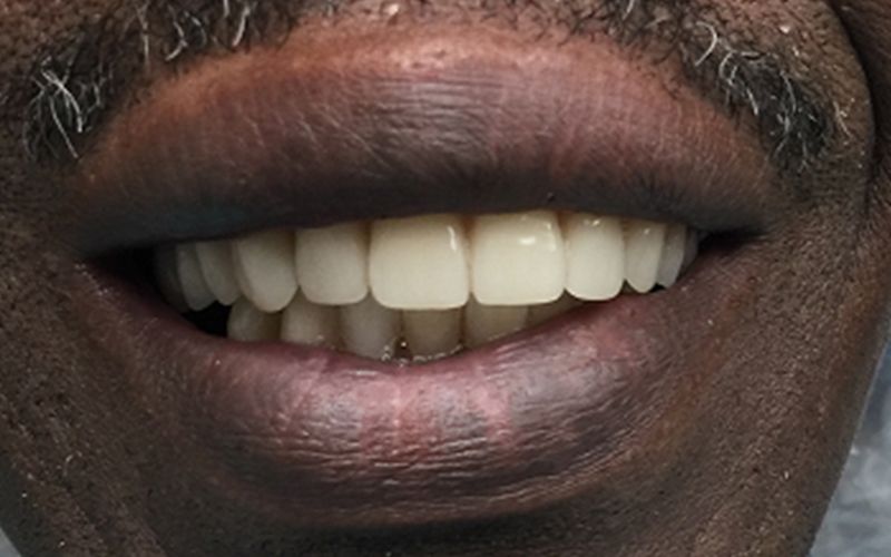 Close-up of a smiling mouth with white teeth and a trimmed mustache.