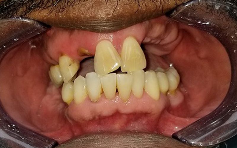 Close-up of open mouth with severe dental crowding and protruding upper teeth