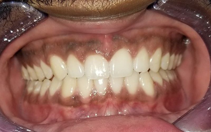 Close-up of a mouth showing teeth and gums, with braces on the lower front teeth.