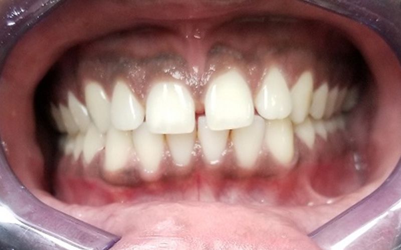 Close-up of a mouth showing crowded upper and lower teeth with a dental retractor