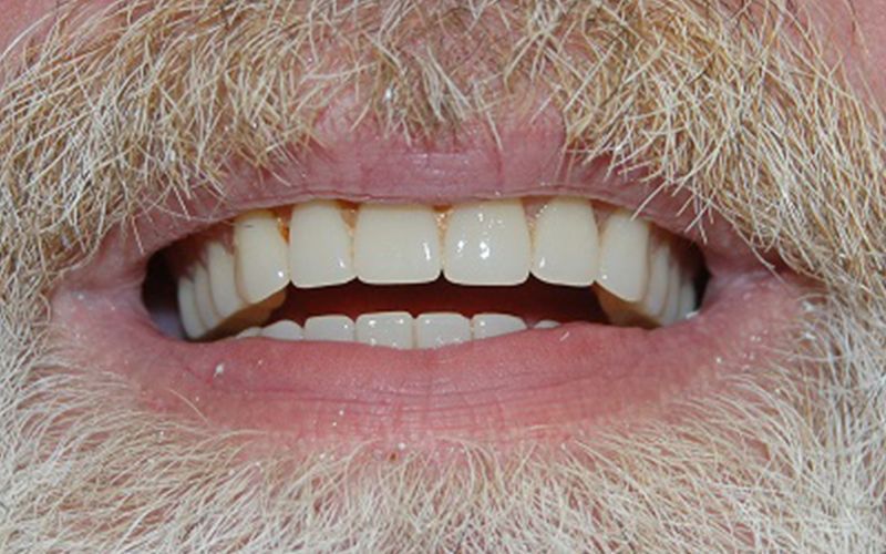 Close-up of a smiling mouth with a white beard and mustache, showing upper and lower teeth.