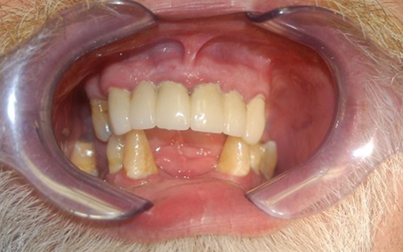 Close-up of upper and lower teeth with several missing lower front teeth, held open by a dental retractor