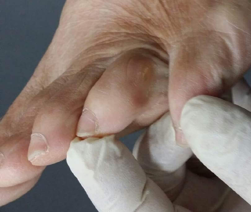 Lateral 4th Corn - Perth, WA - Centrepod Podiatry