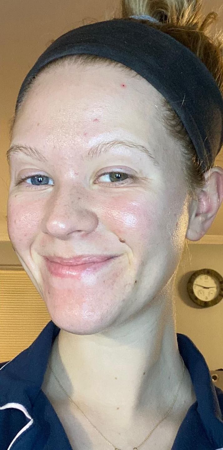 After acne treatment