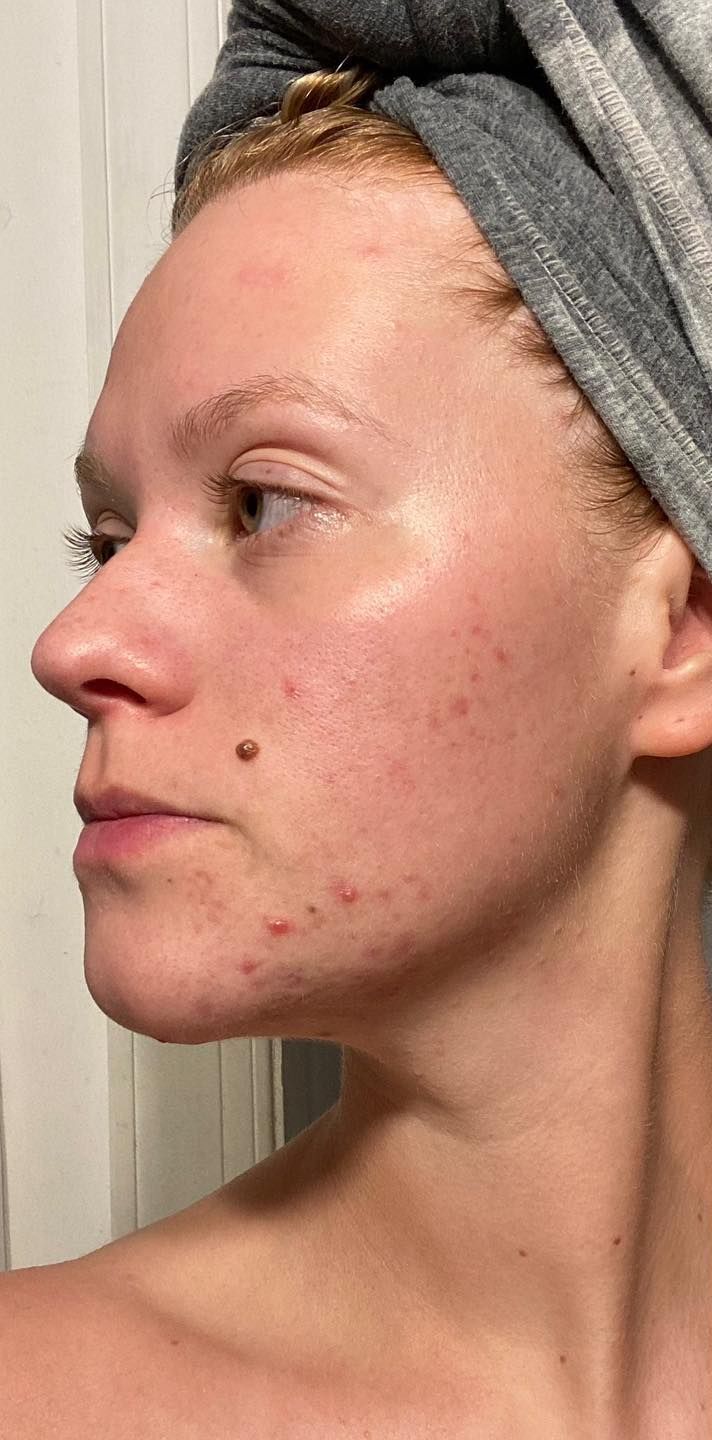 before acne treatment