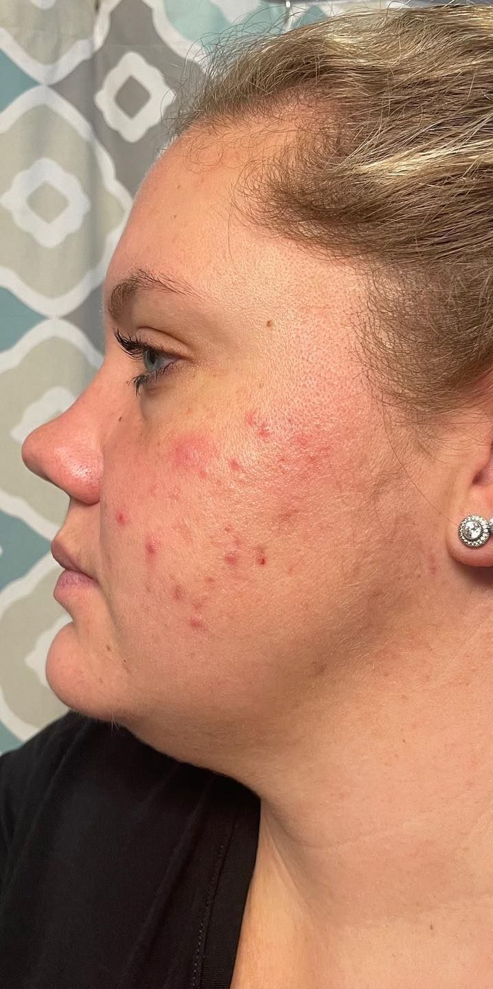 before acne treatment