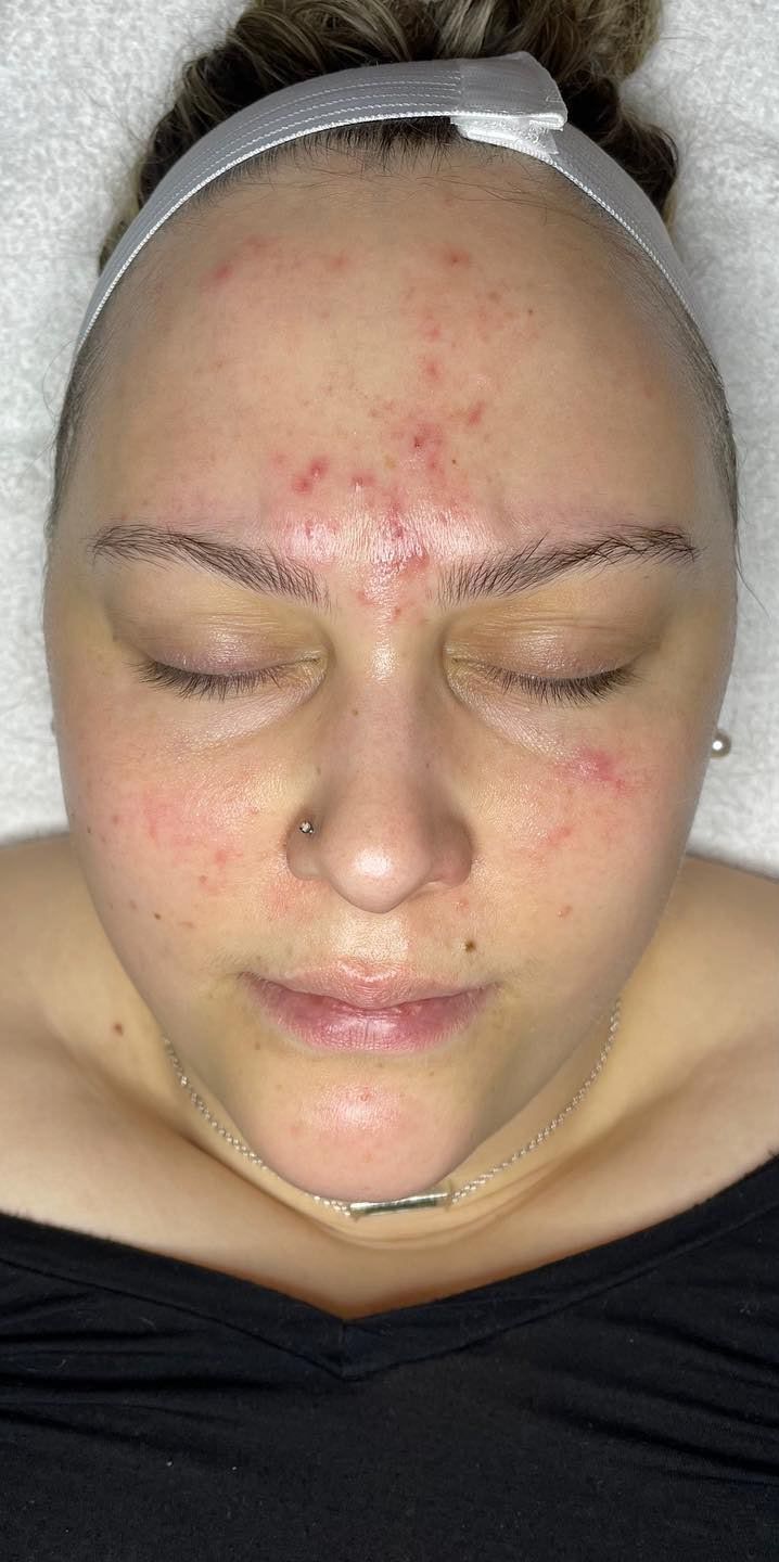 before acne treatment