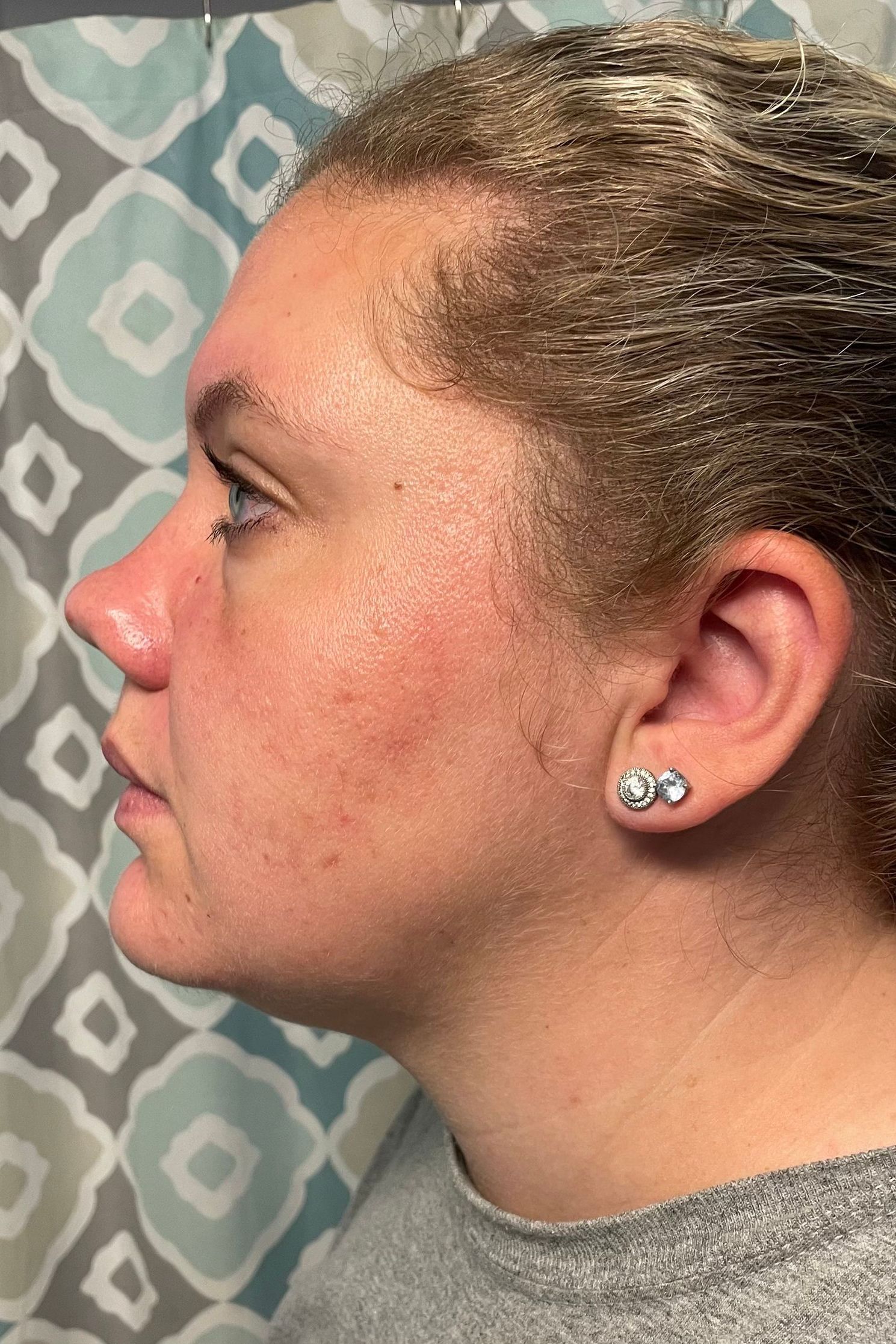 After acne treatment