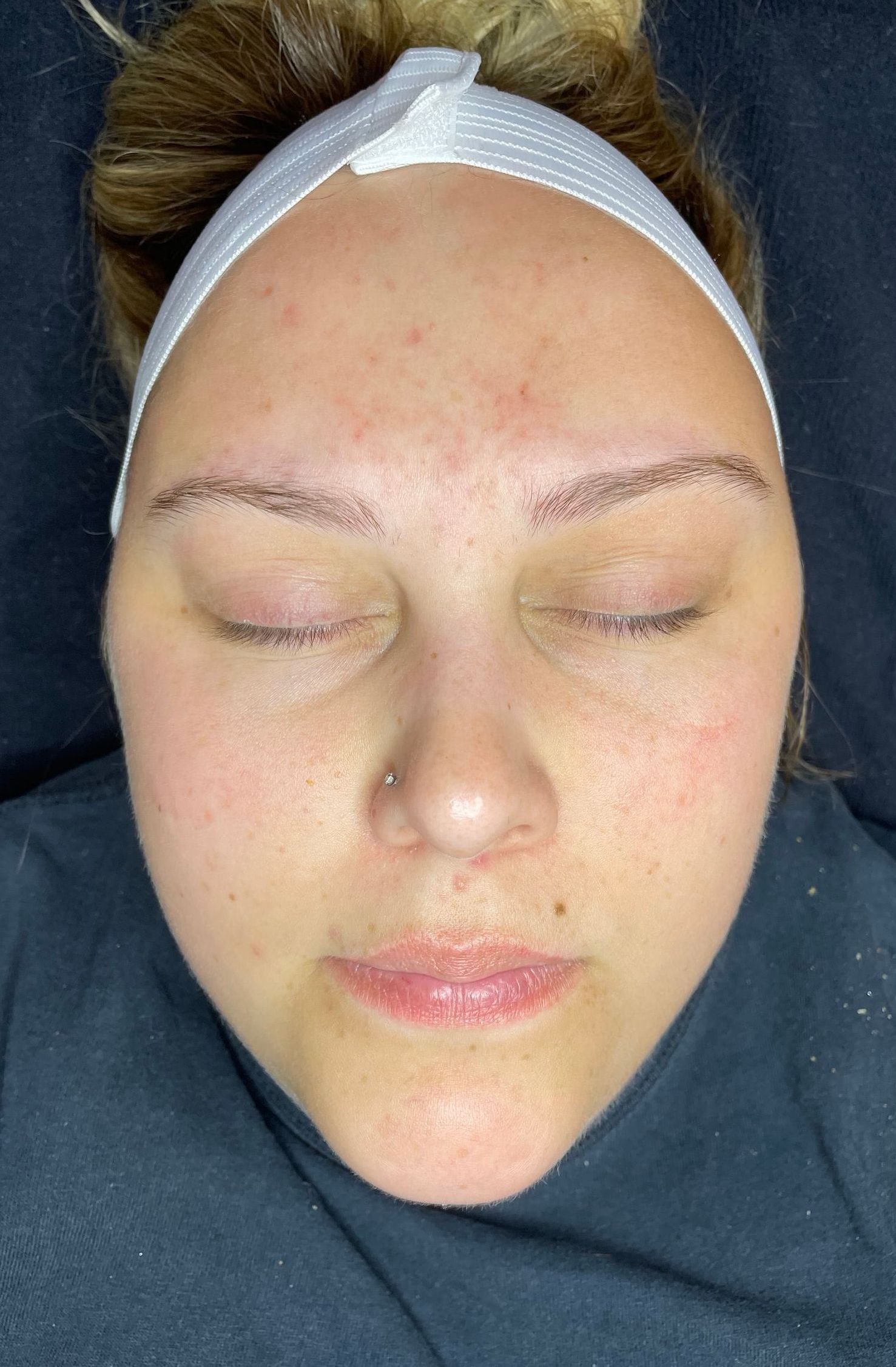 After acne treatment