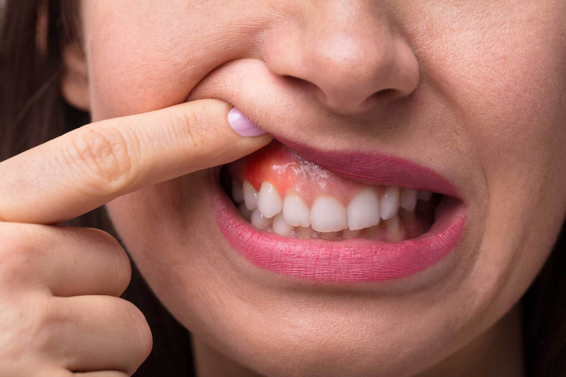 Woman Showing Swelling of Her Gum — Barnwell, SC — Still & Reece Dentistry