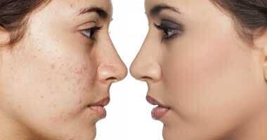 DR. ENRIQUE GONZÁLEZ VILLALOBOS - microdermoabrasión