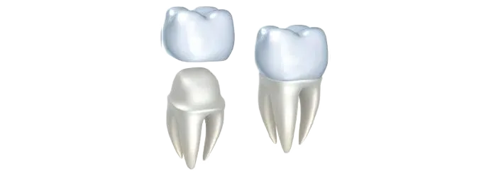 3D illustration of a dental crown being fitted over a prepared tooth at a dentist near Southampton