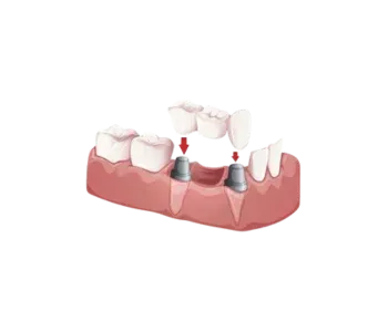 3D illustration of a dental bridge being fitted over a gap between teeth at a dentist near Southampton