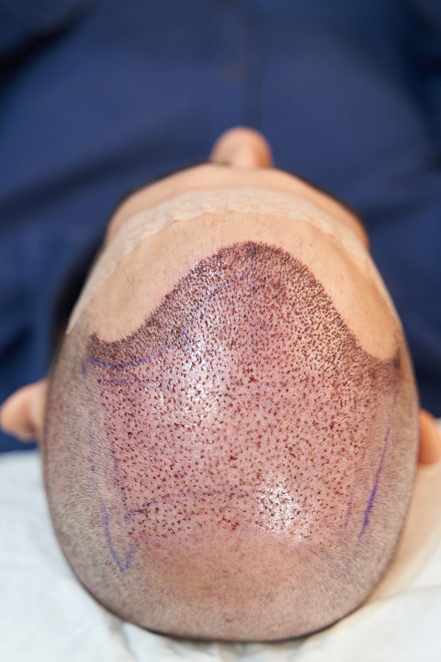 Vista de arriba hacia abajo de un cuero cabelludo afeitado con puntos y marcas, posiblemente indicando un procedimiento de trasplante de cabello.