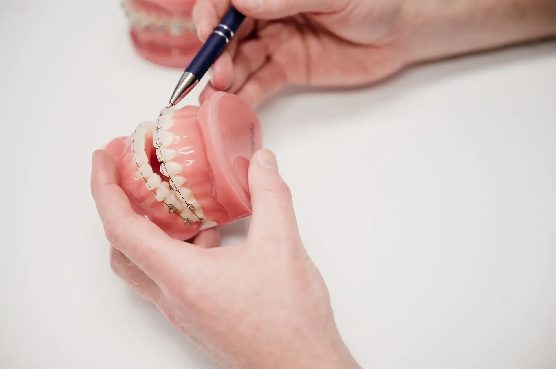 At Olliver Orthodontics we offer both metal and ceramic clear options for braces, as well as aligner treatments such as Spark and Invisalign.