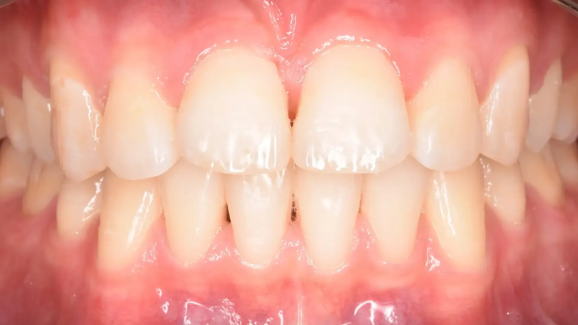 Increased Overbite, Deepbite After Photo | Olliver Orthodontics NZ