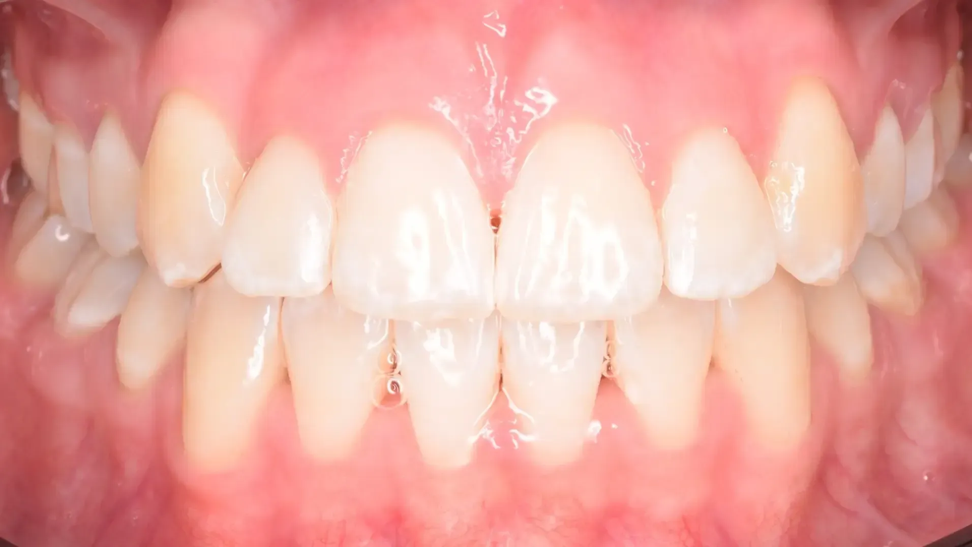 Crowded Teeth After Photo | Olliver Orthodontics NZ