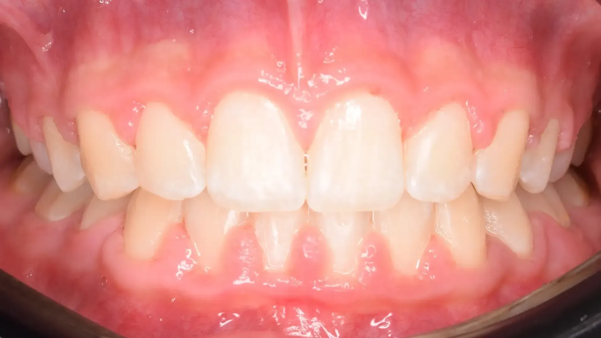 Crowded Teeth, Midline Discrepancies - After Photo | Olliver Orthodontics NZ