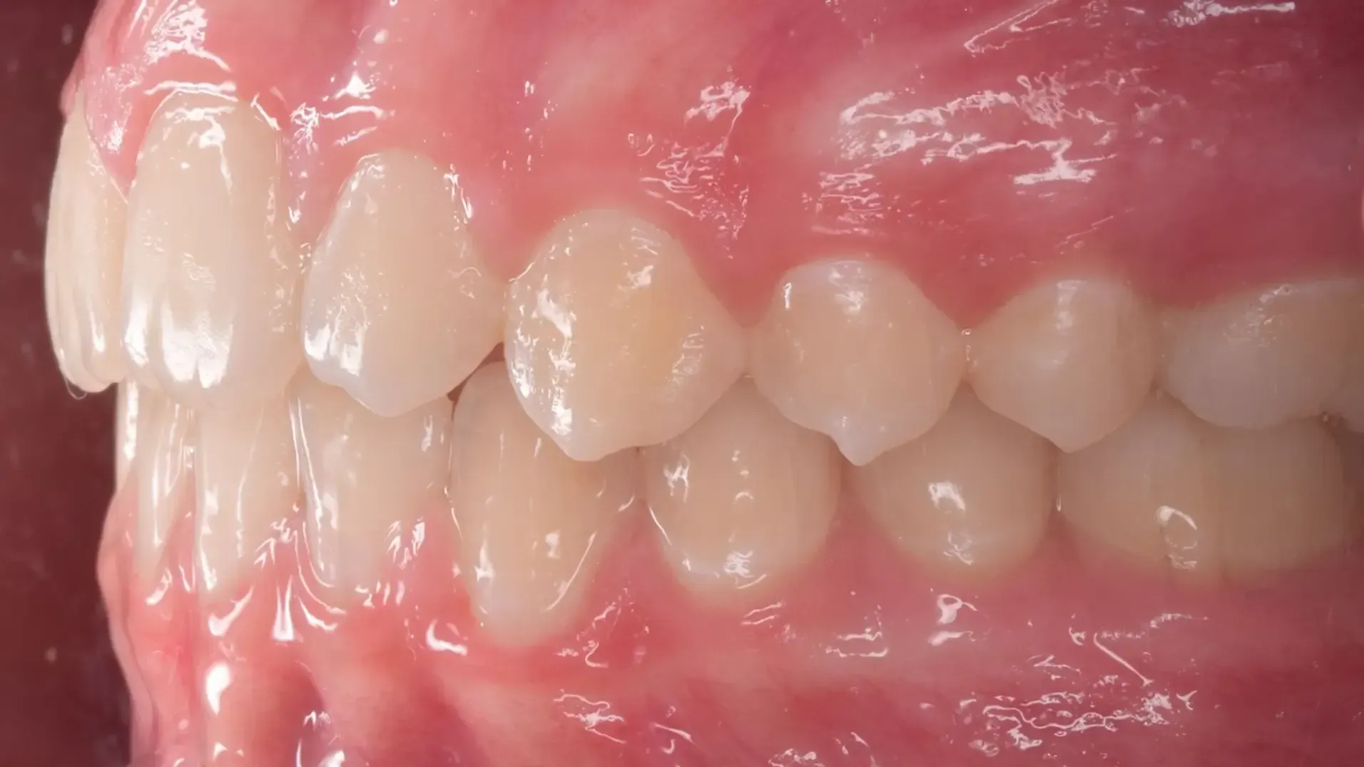 Increased Overjet After Photo | Olliver Orthodontics NZ