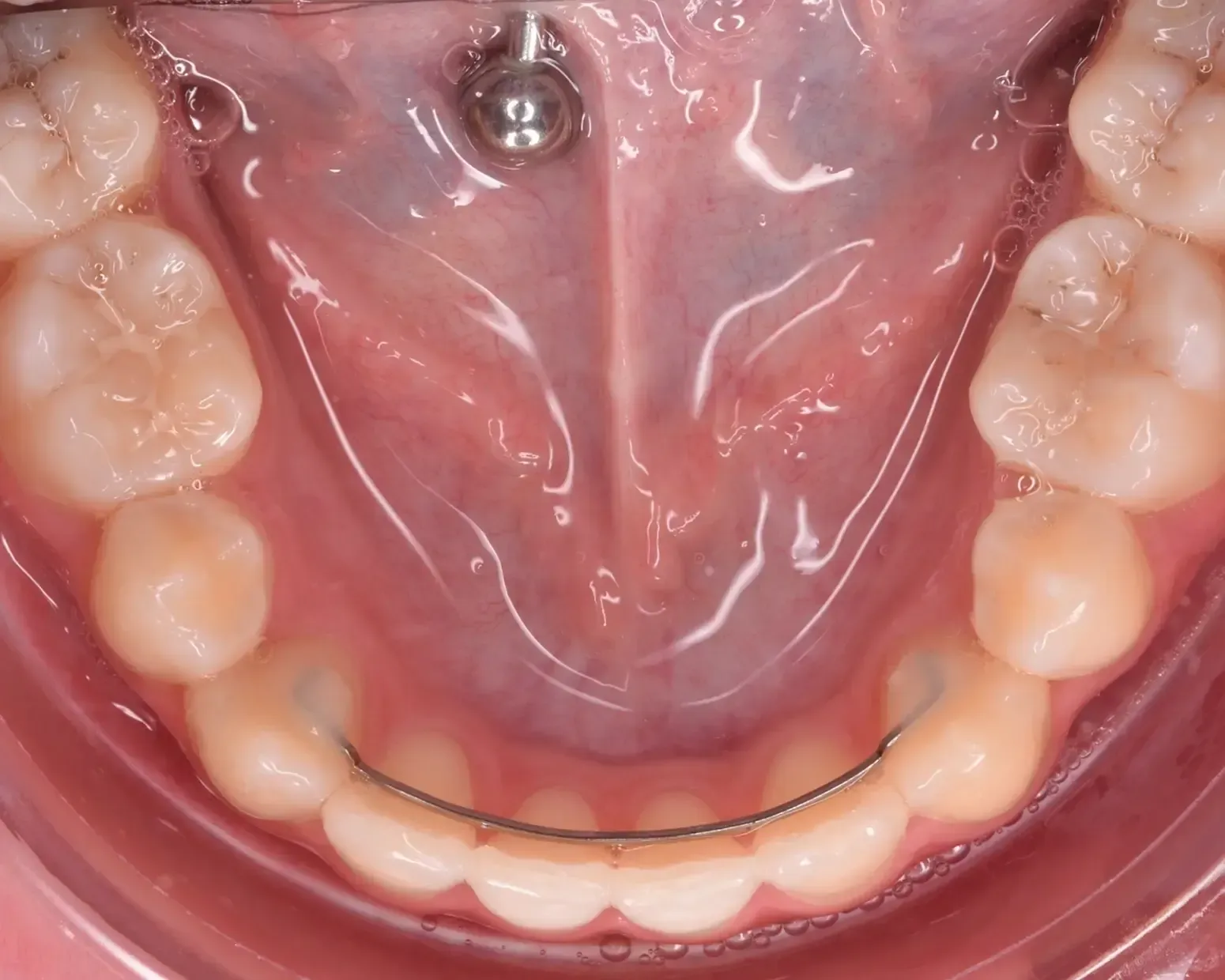 Missing Teeth, Space Closure After Photo | Olliver Orthodontics NZ