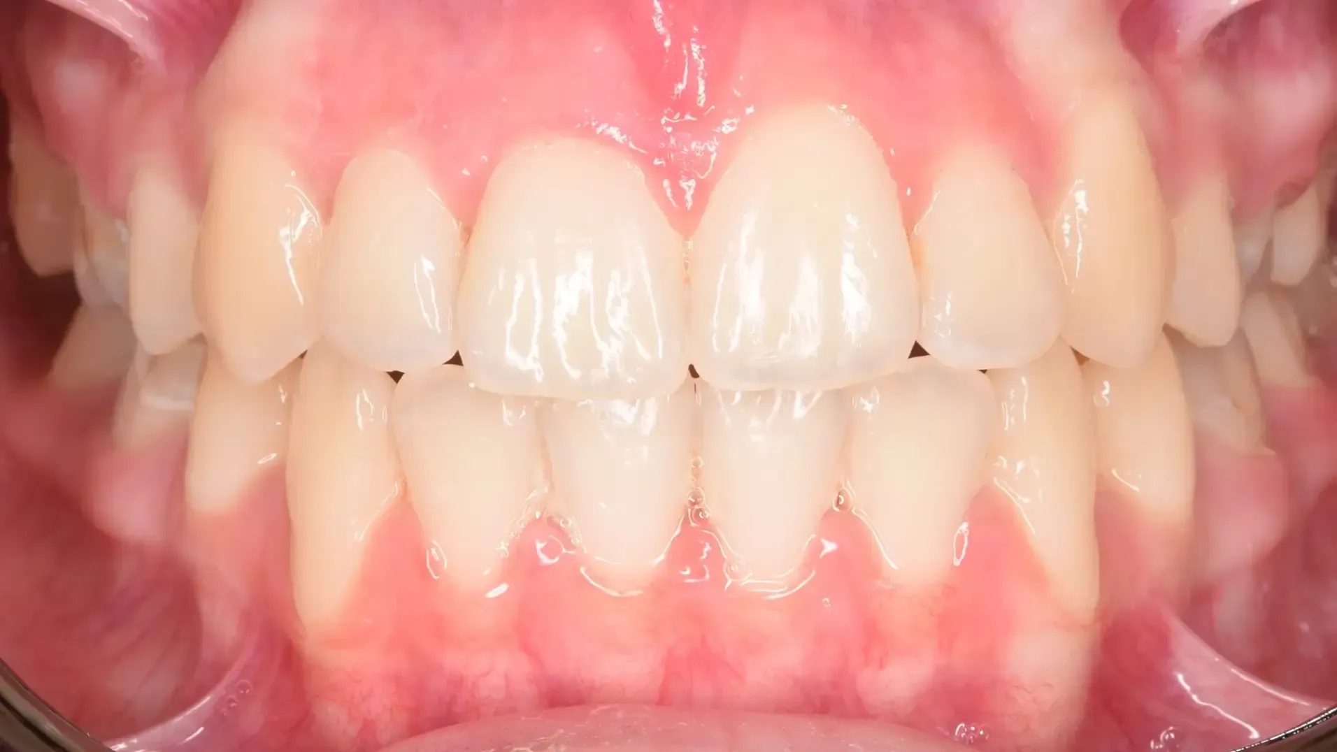 Crowded Teeth Afte Photo | Olliver Orthodontics NZ
