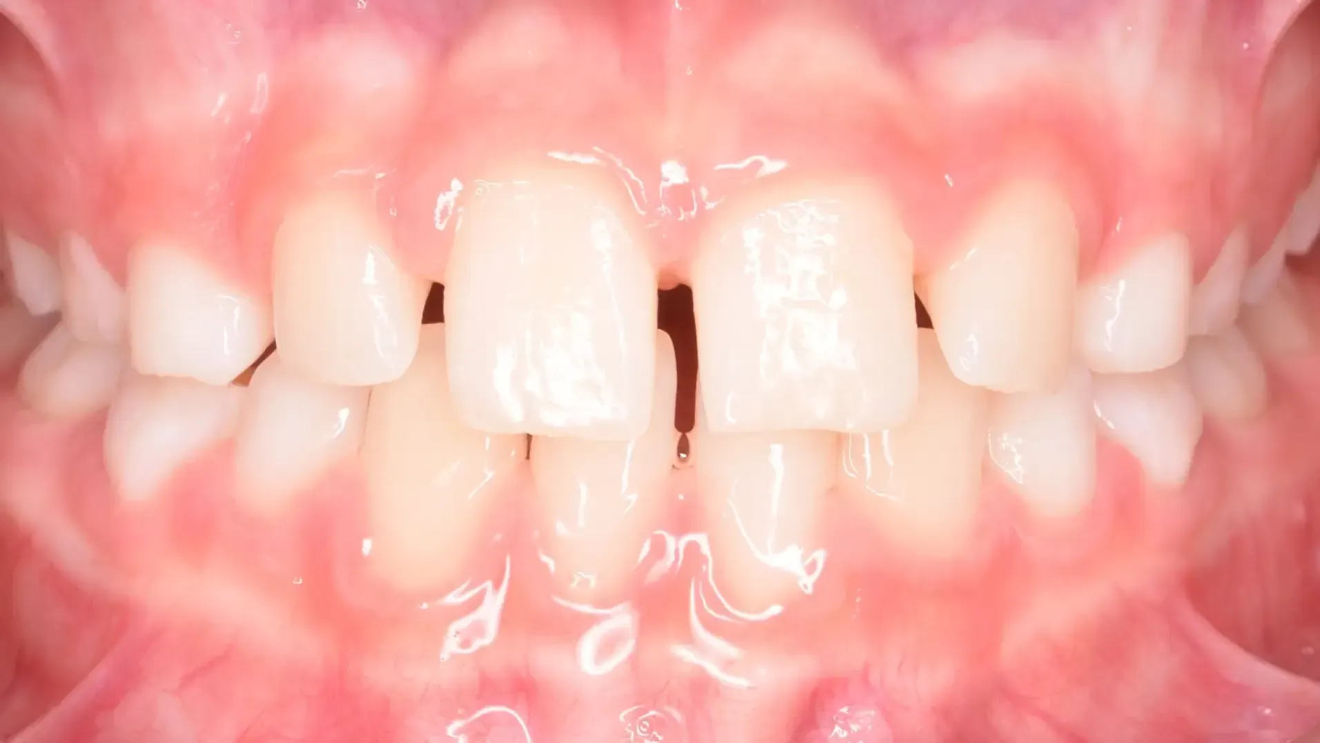 Cross Bite, Early Treatment After Photo | Olliver Orthodontics NZ