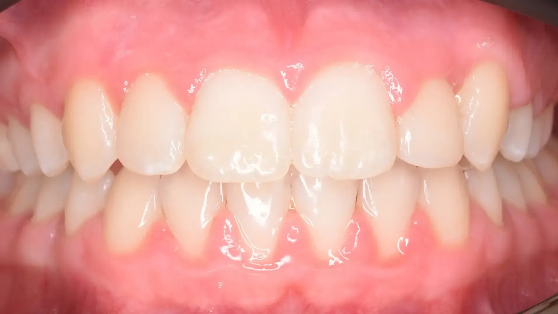 Ectopic Canine, Crowded Teeth After Photo | Olliver Orthodontics NZ