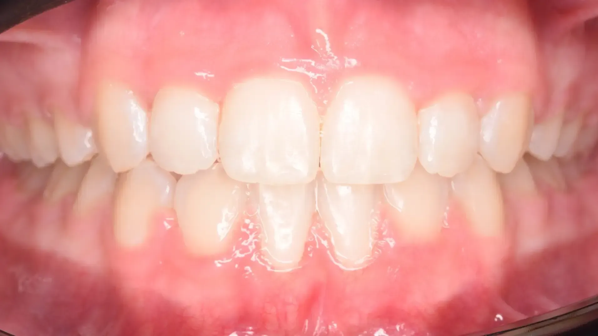 Missing Teeth, Space Closure After Photo | Olliver Orthodontics NZ