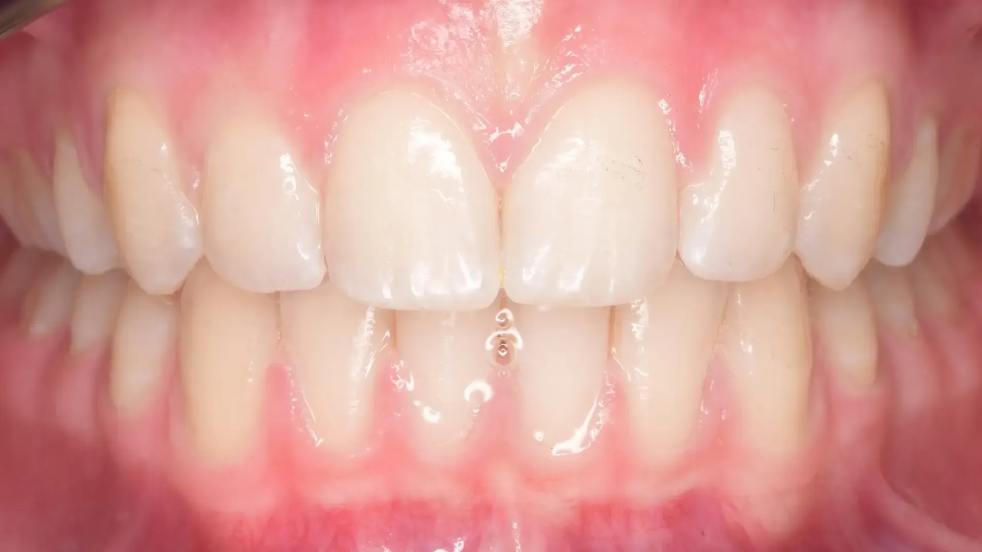 Deep Bite, Crowded Teeth After Photo | Olliver Orthodontics NZ