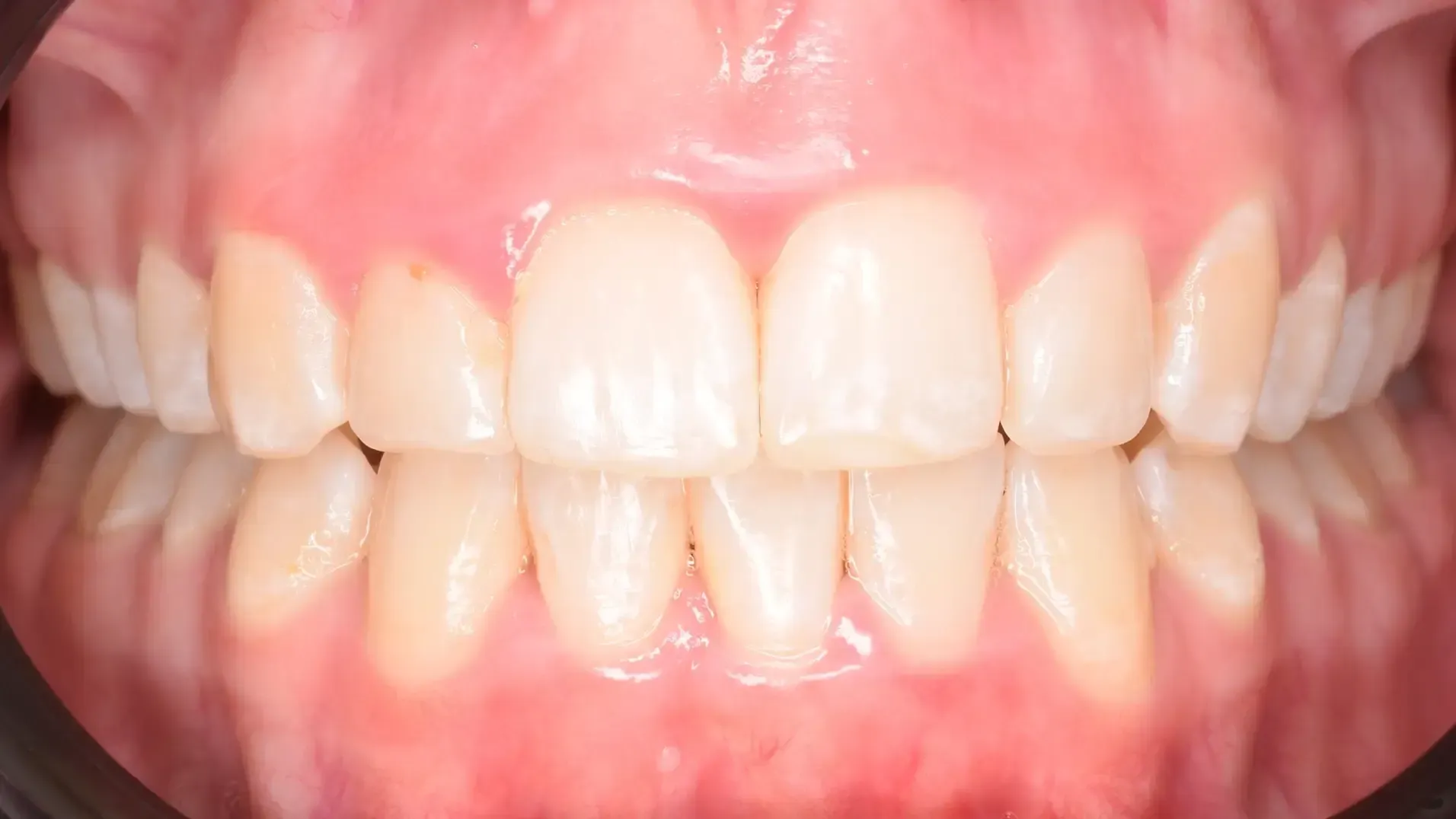 Aligners, Lower Incisor Extraction After Photo | Olliver Orthodontics NZ