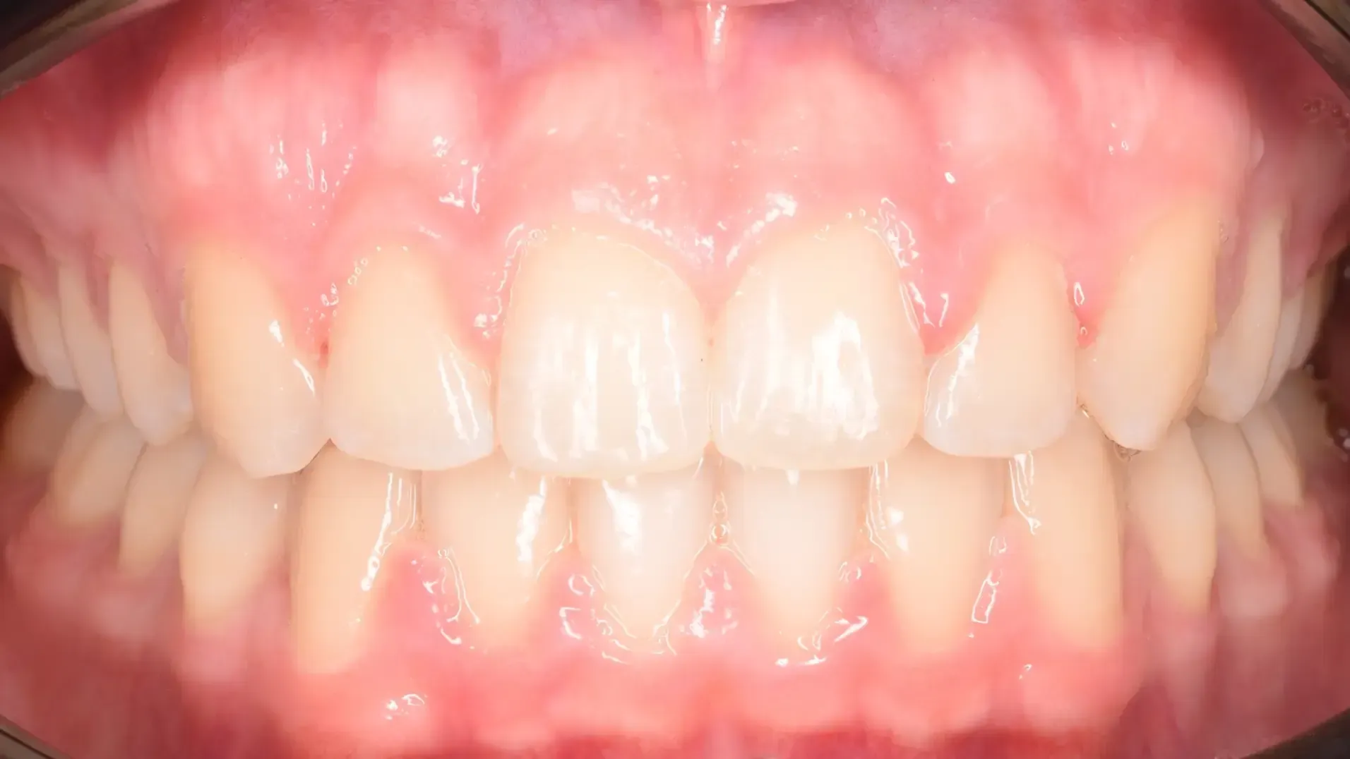 Splayed Teeth, Diastema After Photo | Olliver Orthodontics NZ