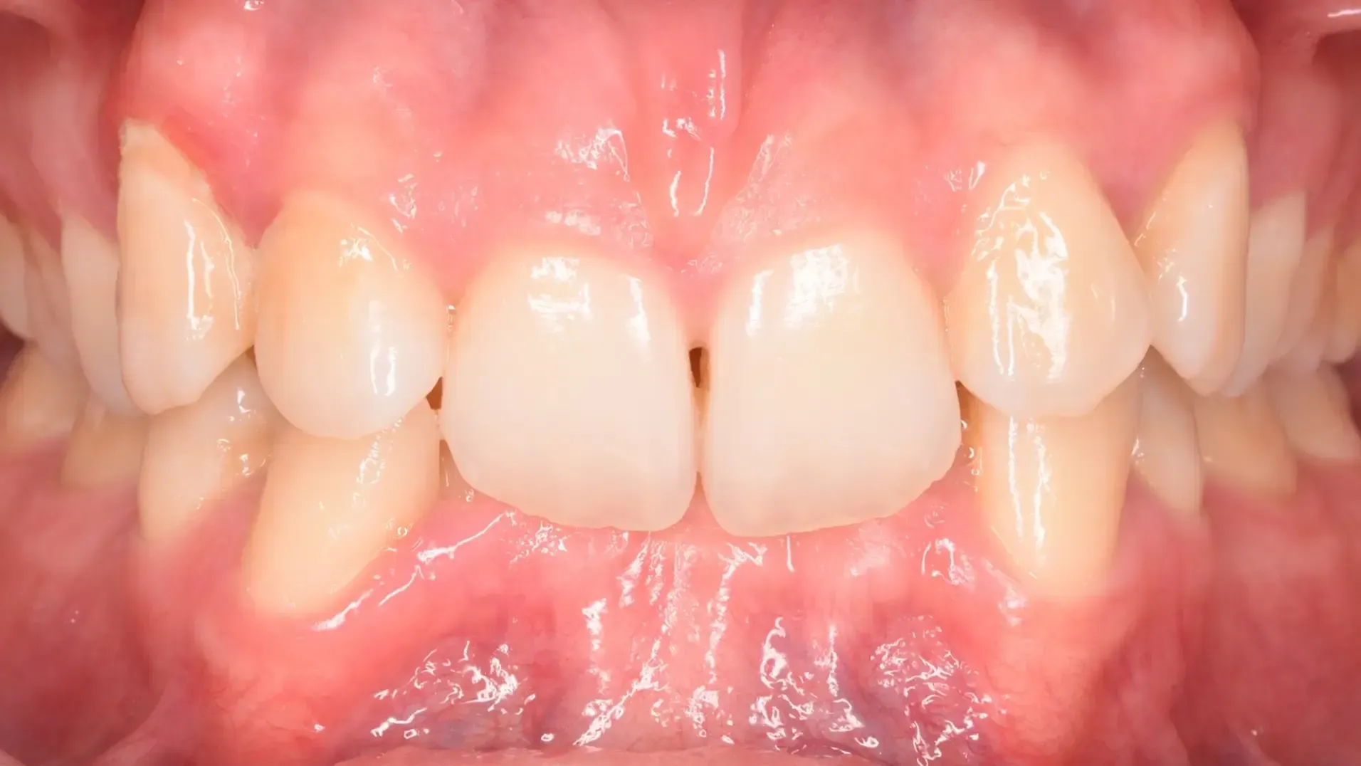 Increased Overbite, Deepbite Before Photo | Olliver Orthodontics NZ