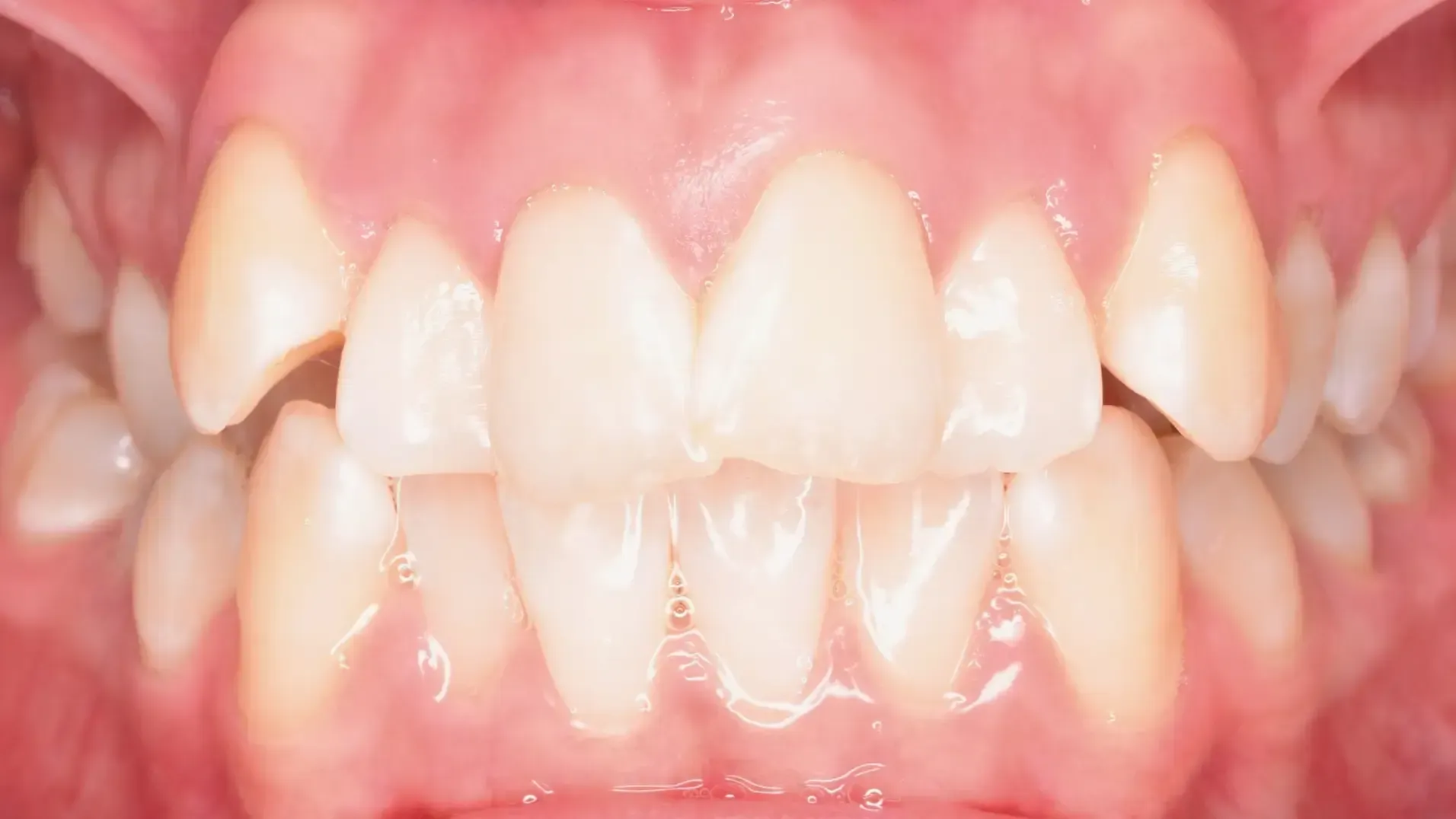 Crowded Teeth Before Photo | Olliver Orthodontics NZ