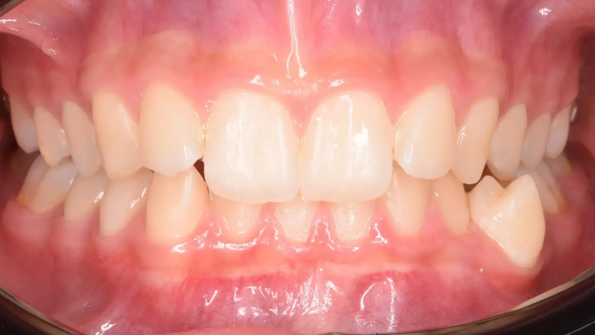 Crowded Teeth, Midline Discrepancies - Before Photo | Olliver Orthodontics NZ