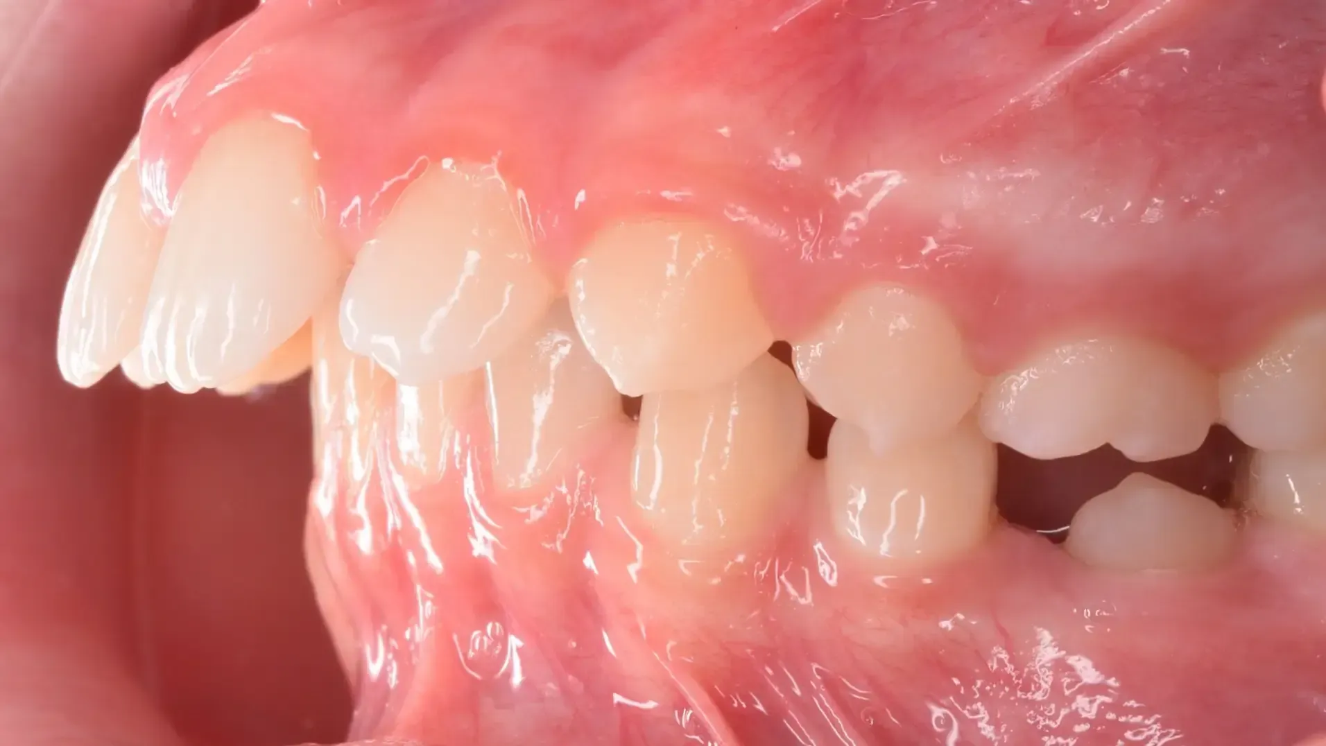 Increased Overjet Before Photo | Olliver Orthodontics NZ