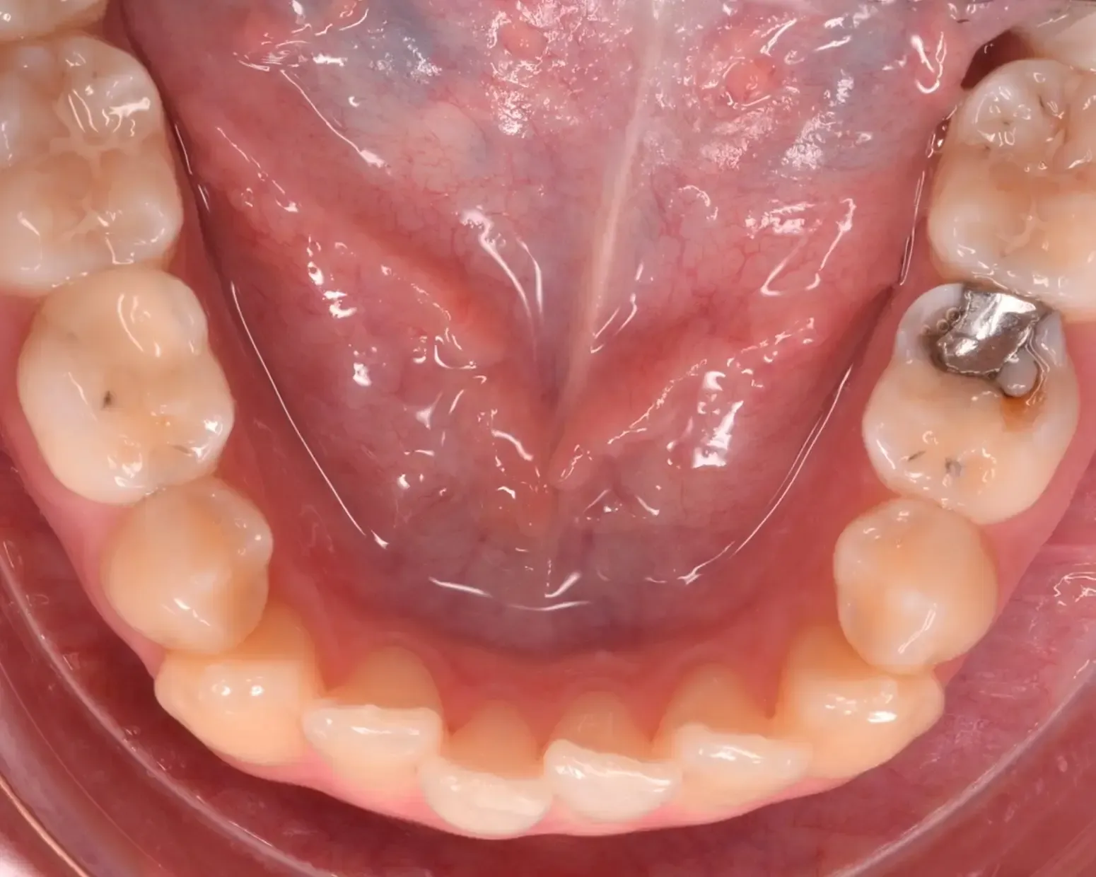 Missing Teeth, Space Closure Before Photo | Olliver Orthodontics NZ