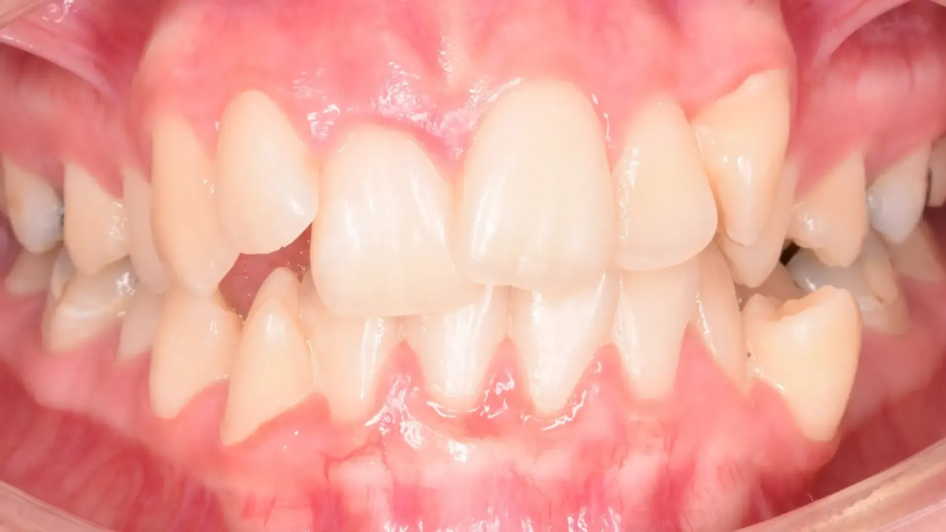 Crowded Teeth Before Photo | Olliver Orthodontics NZ