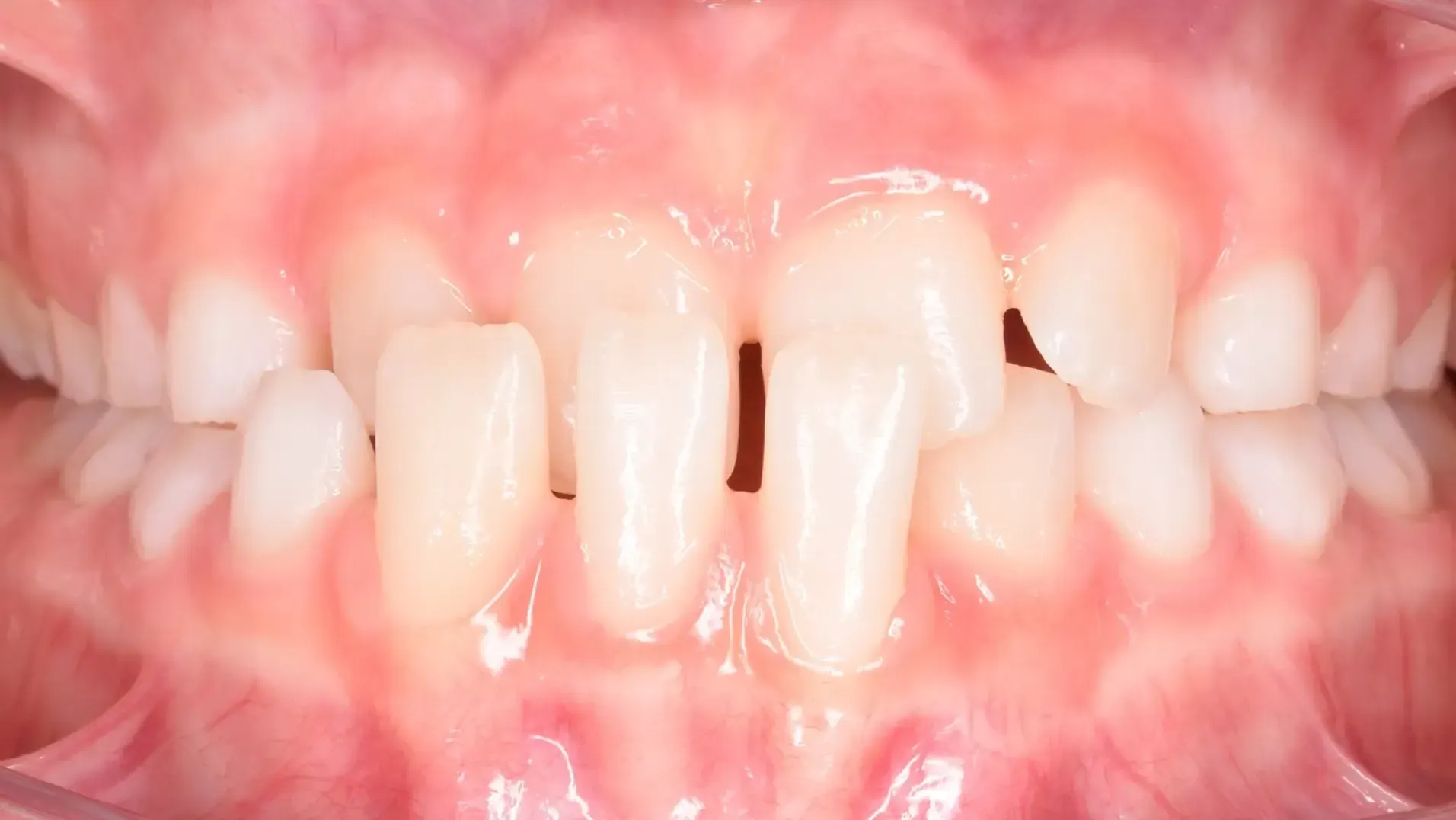 Cross Bite, Early Treatment Before Photo | Olliver Orthodontics NZ