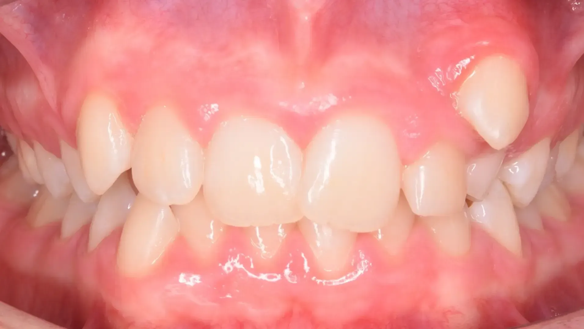Ectopic Canine, Crowded Teeth Before Photo | Olliver Orthodontics NZ
