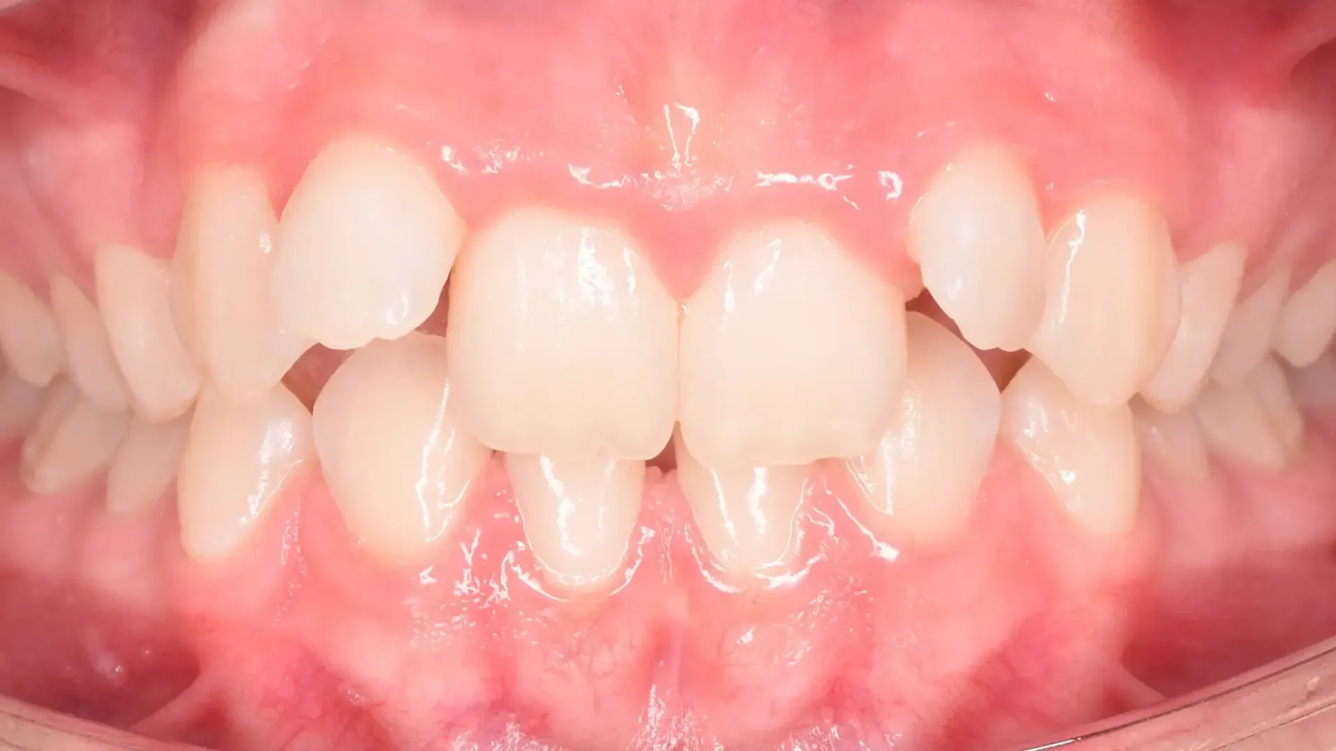 Missing Teeth, Space Closure Before Photo | Olliver Orthodontics NZ