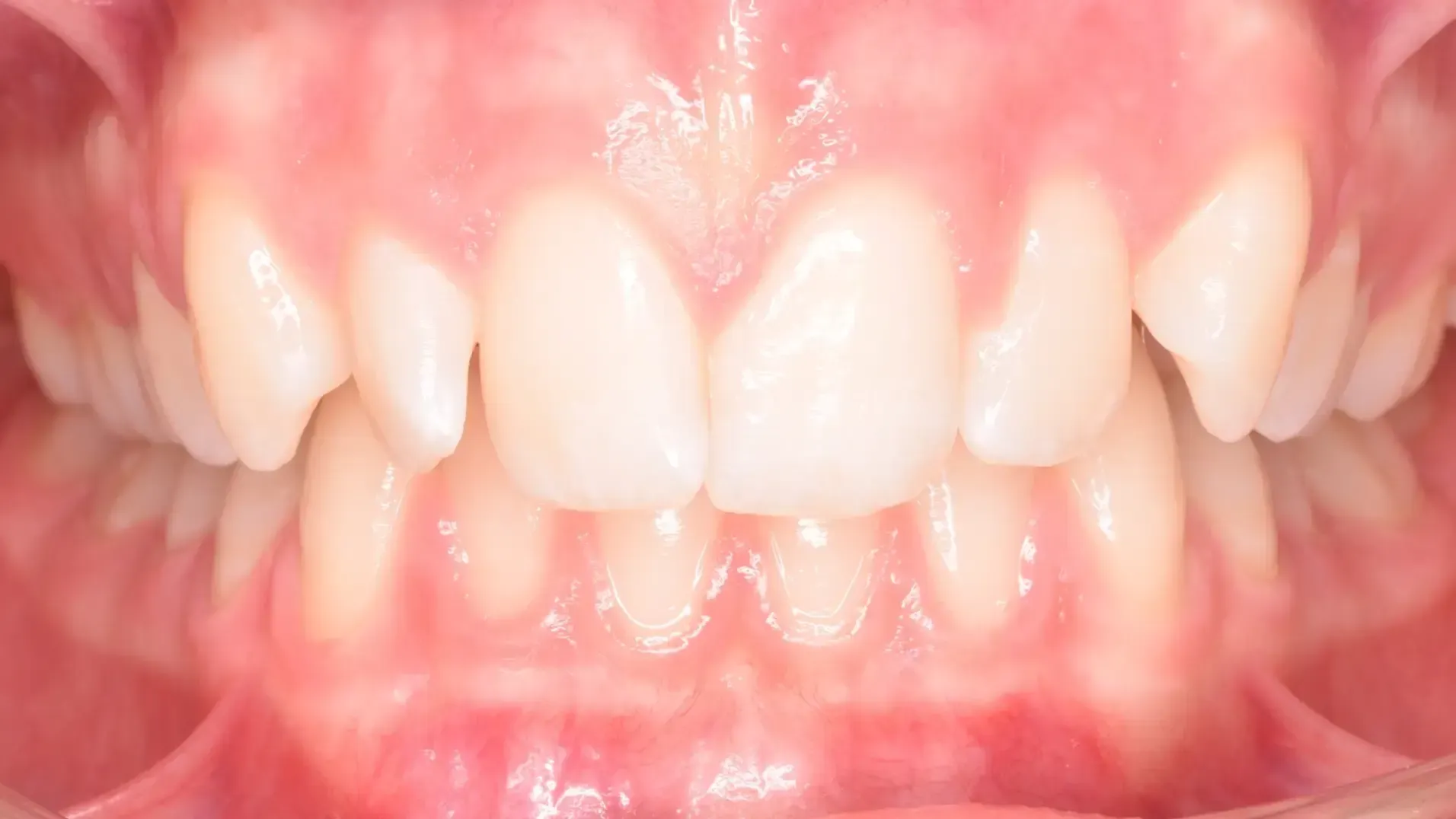 Deep Bite, Crowded Teeth Before Photo | Olliver Orthodontics NZ