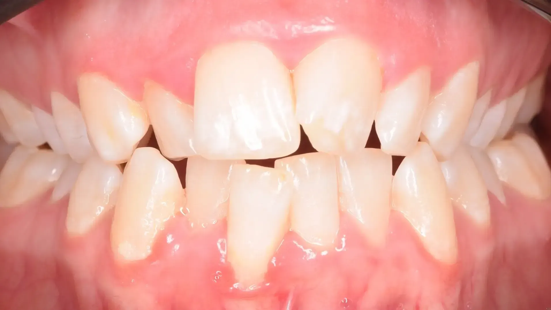 Aligners, Lower Incisor Extraction Before Photo | Olliver Orthodontics NZ