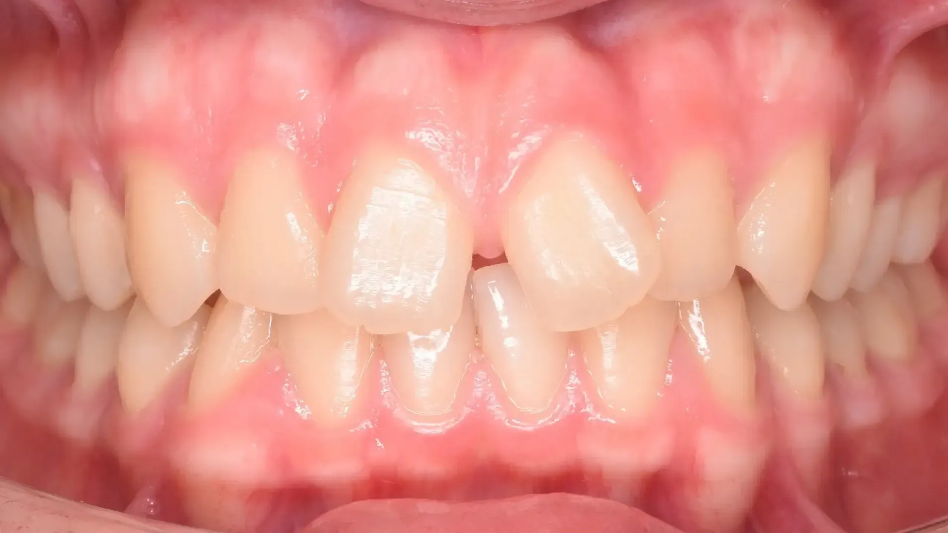 Splayed Teeth, Diastema Before Photo | Olliver Orthodontics NZ