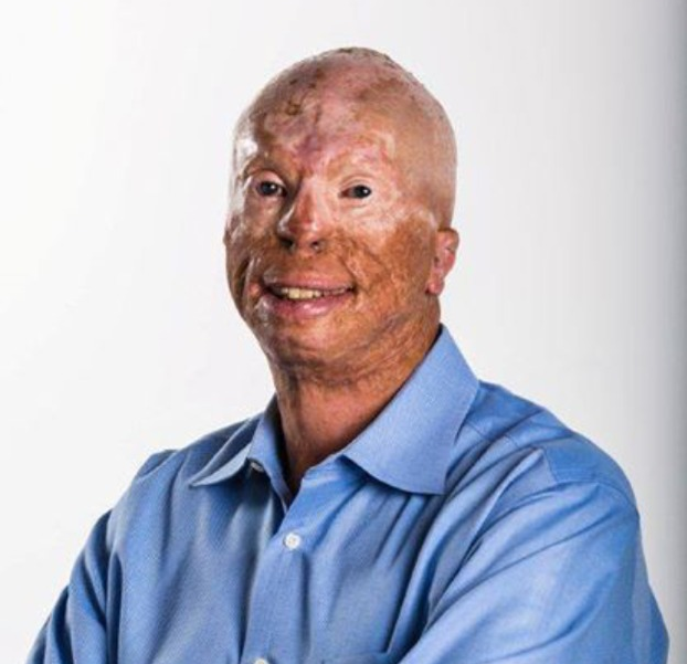Man with visible skin scarring smiles, wearing a blue button-down shirt, against a white background.