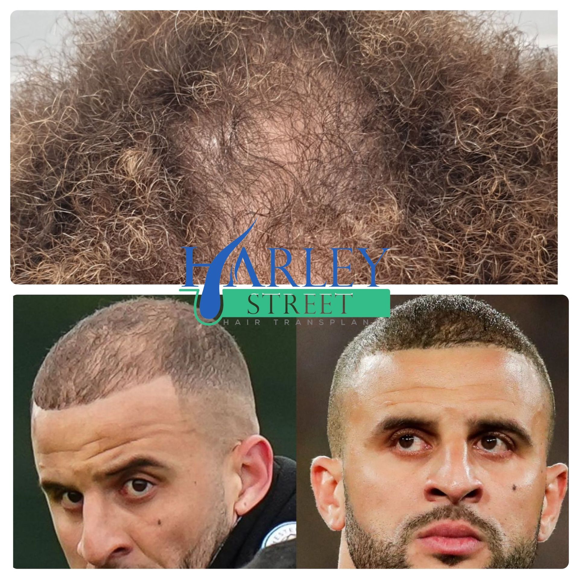 Crown hair transplant before and after result