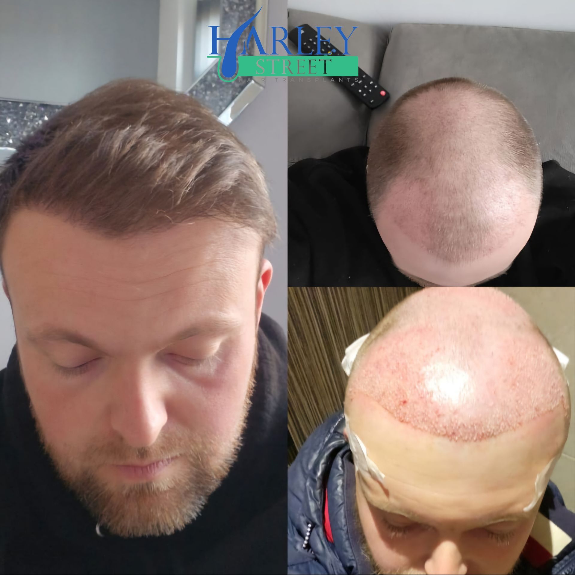 Dan hair transplant before and after results