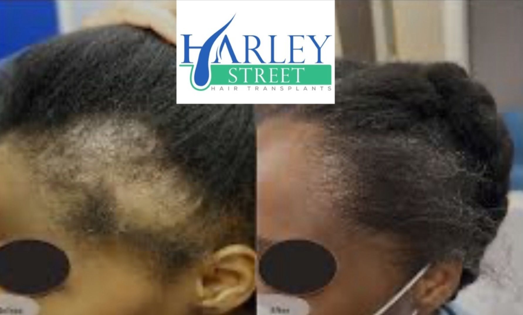 Afro traction hair-loss restoration result