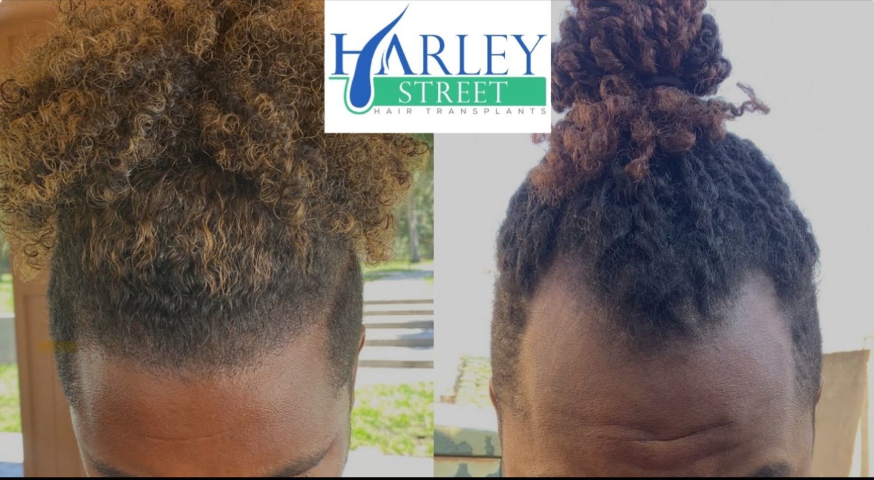 Jackie hair transplant before and after results