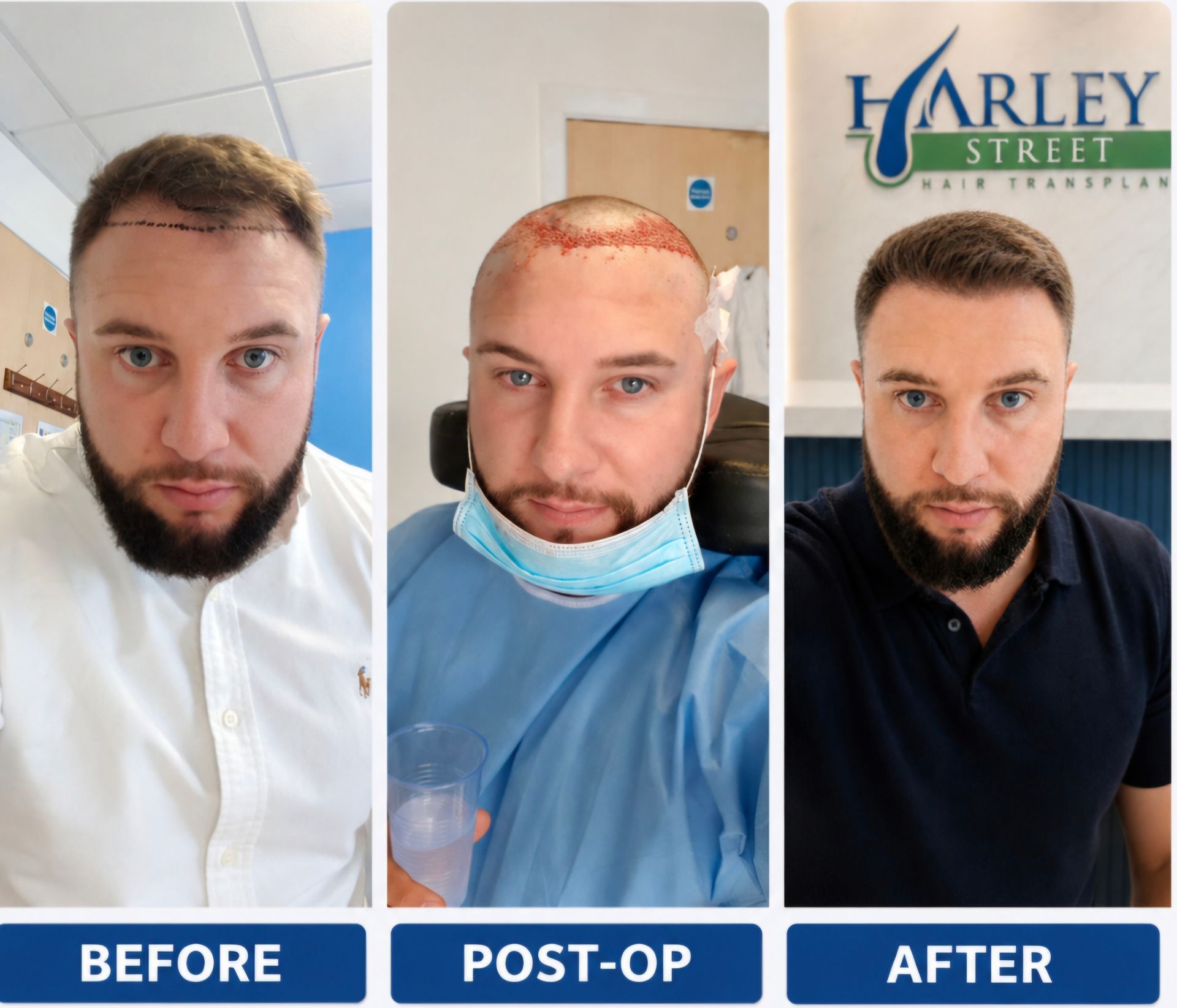 Dean hair transplant before and after results