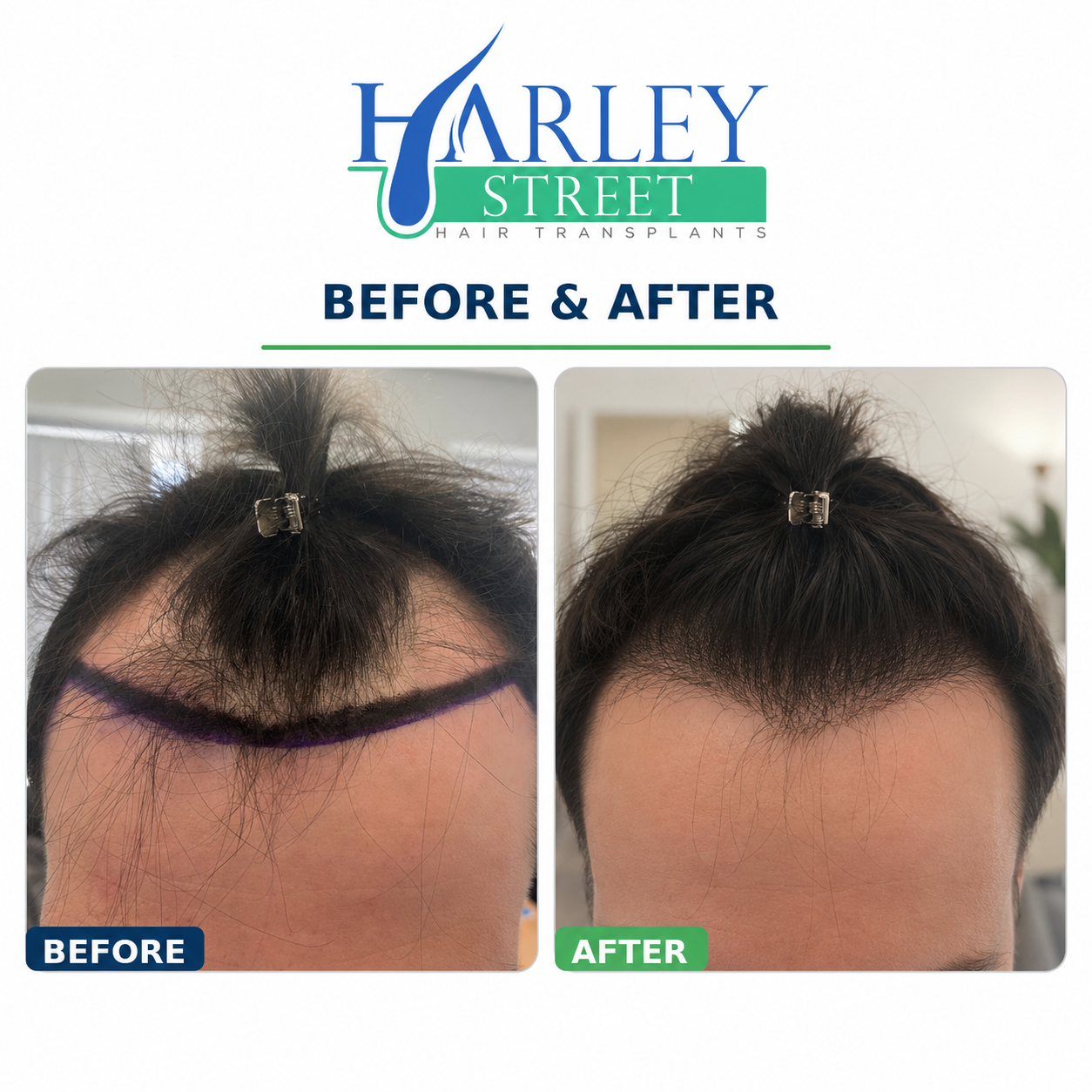 Temple recession and frontal corner hair restoration